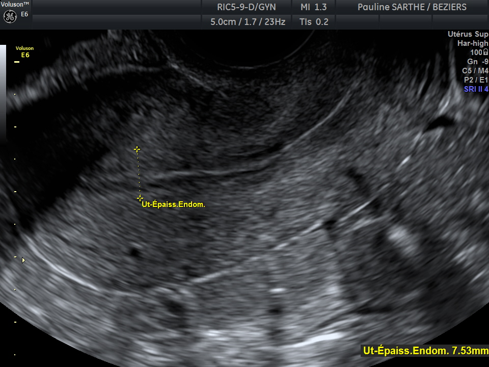 4 premiere semaines echographie échographie de